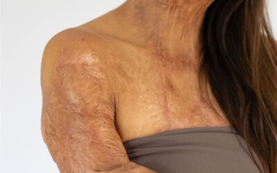 Understanding Burn Scar Treatment Options