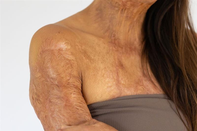 Understanding Burn Scar Treatment Options